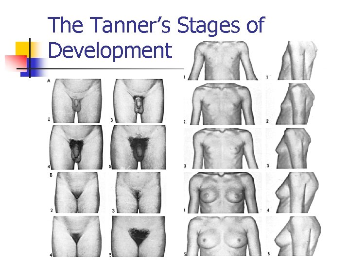 The Tanner’s Stages of Development 