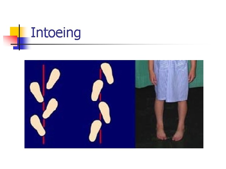 Intoeing 