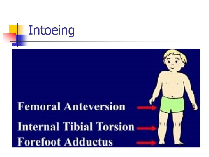 Intoeing 