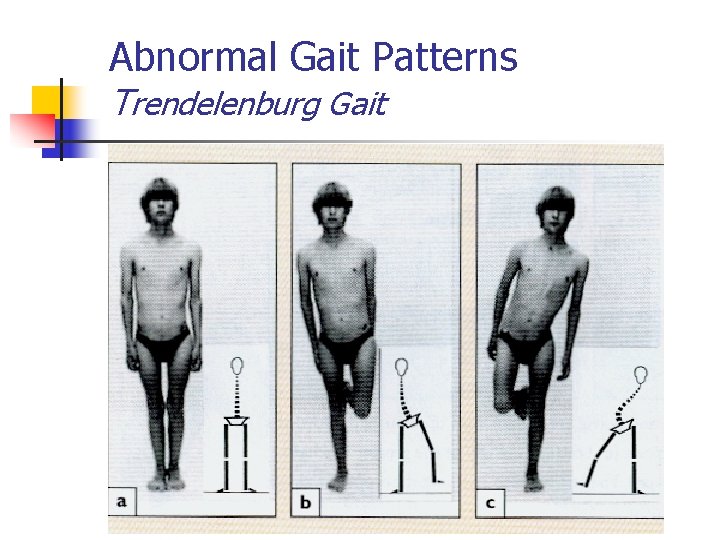 Abnormal Gait Patterns Trendelenburg Gait 