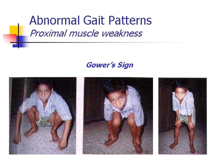 Abnormal Gait Patterns Proximal muscle weakness Gower’s Sign 