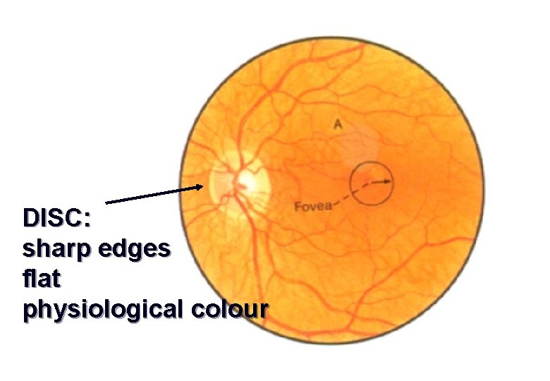 DISC: sharp edges flat physiological colour 