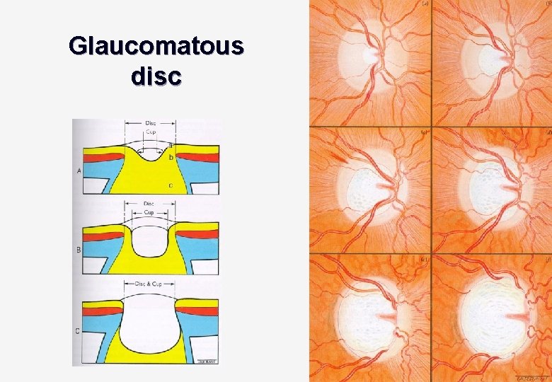 Glaucomatous disc 