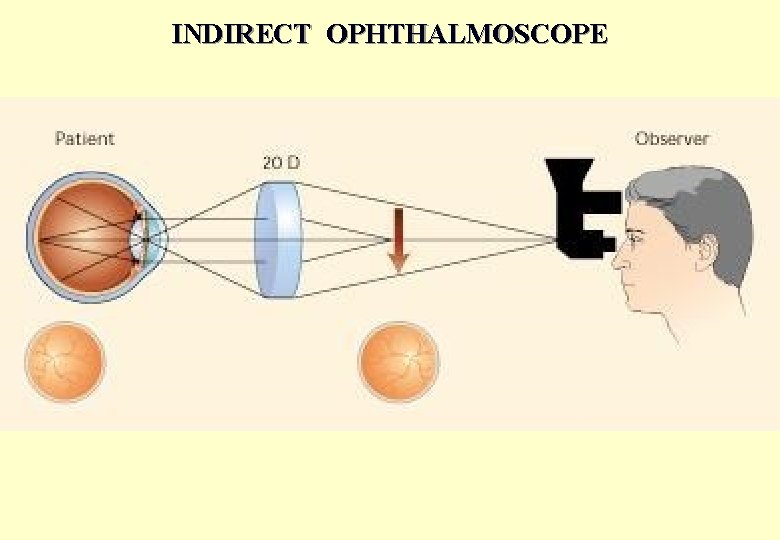 INDIRECT OPHTHALMOSCOPE 