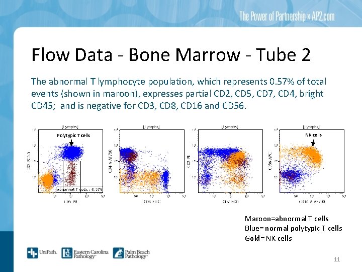 Flow Data - Bone Marrow - Tube 2 The abnormal T lymphocyte population, which