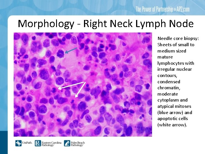 Morphology - Right Neck Lymph Node Needle core biopsy: Sheets of small to medium