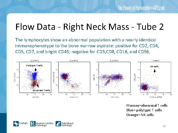 Flow Data - Right Neck Mass - Tube 2 The lymphocytes show an abnormal