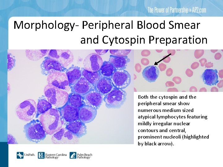 Morphology- Peripheral Blood Smear and Cytospin Preparation Both the cytospin and the peripheral smear