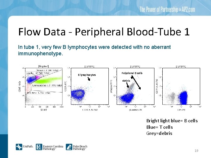 Flow Data - Peripheral Blood-Tube 1 In tube 1, very few B lymphocytes were