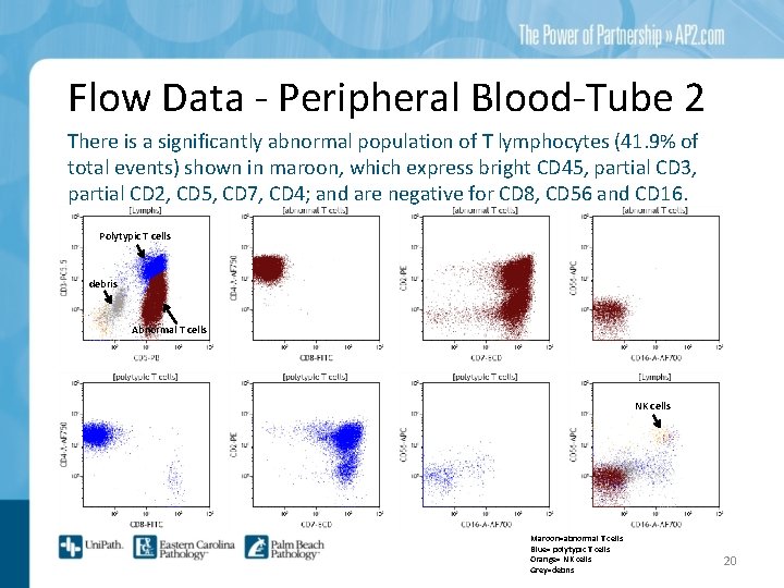 Flow Data - Peripheral Blood-Tube 2 There is a significantly abnormal population of T