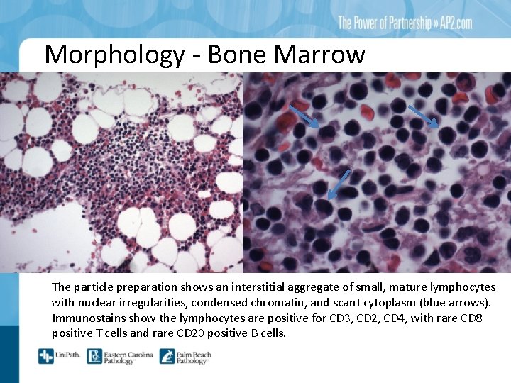 Morphology - Bone Marrow The particle preparation shows an interstitial aggregate of small, mature