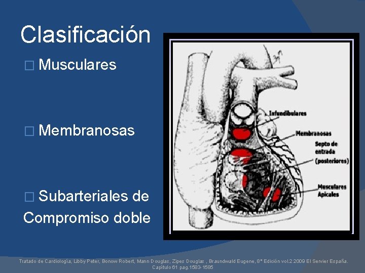 Clasificación � Musculares � Membranosas � Subarteriales de Compromiso doble Tratado de Cardiología, Libby