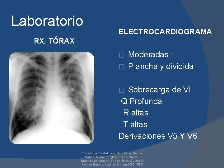 Laboratorio ELECTROCARDIOGRAMA RX. TÓRAX Moderadas : � P ancha y dividida � Sobrecarga de