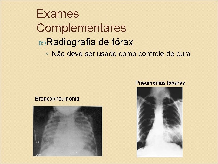 Exames Complementares Radiografia de tórax ◦ Não deve ser usado como controle de cura