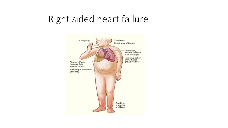 Right sided heart failure 