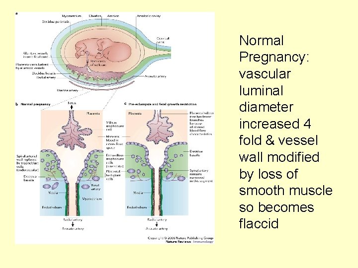 Normal Pregnancy: vascular luminal diameter increased 4 fold & vessel wall modified by loss