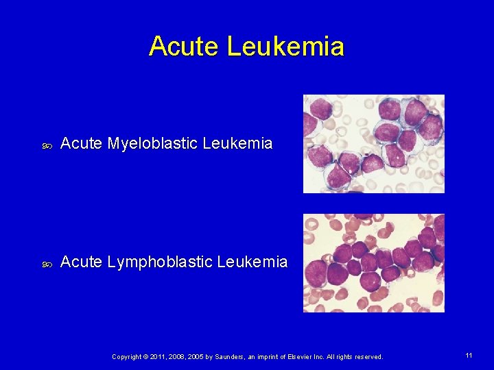 Acute Leukemia Acute Myeloblastic Leukemia Acute Lymphoblastic Leukemia Copyright © 2011, 2008, 2005 by