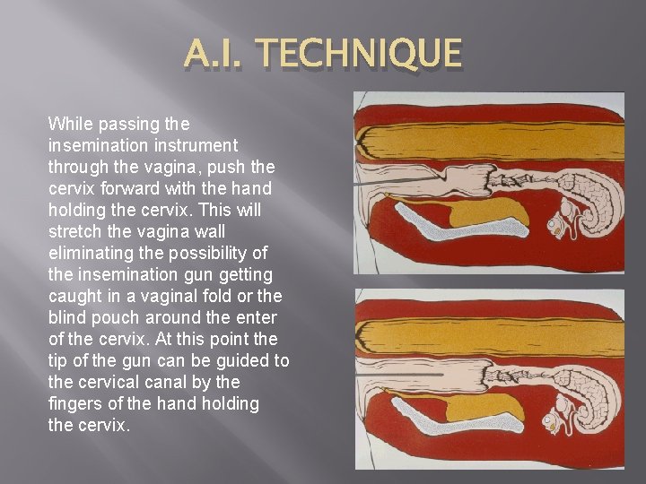 A. I. TECHNIQUE While passing the insemination instrument through the vagina, push the cervix