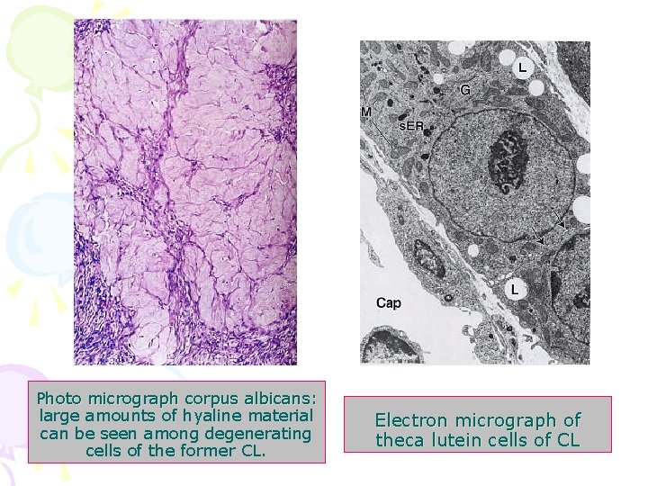Photo micrograph corpus albicans: large amounts of hyaline material can be seen among degenerating
