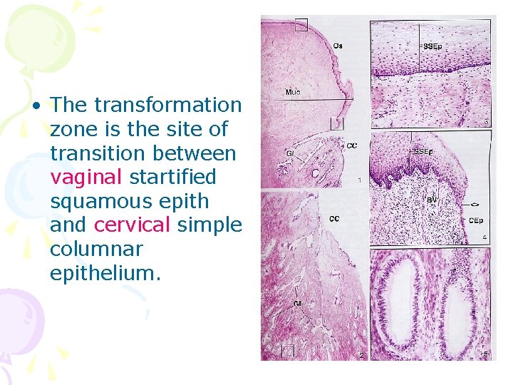  • The transformation zone is the site of transition between vaginal startified squamous