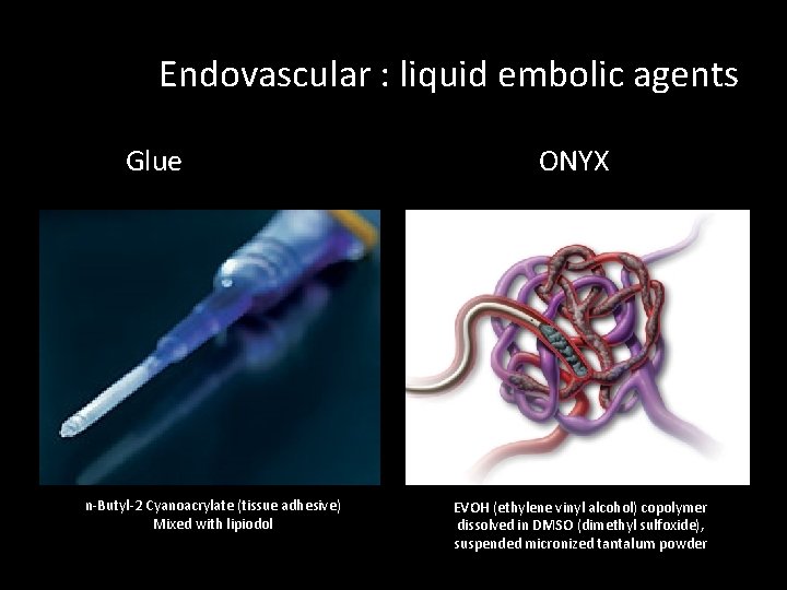 Endovascular : liquid embolic agents Glue n-Butyl-2 Cyanoacrylate (tissue adhesive) Mixed with lipiodol ONYX Endovascular : liquid embolic agents Glue n-Butyl-2 Cyanoacrylate (tissue adhesive) Mixed with lipiodol ONYX