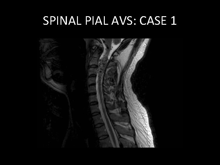 SPINAL PIAL AVS: CASE 1 SPINAL PIAL AVS: CASE 1
