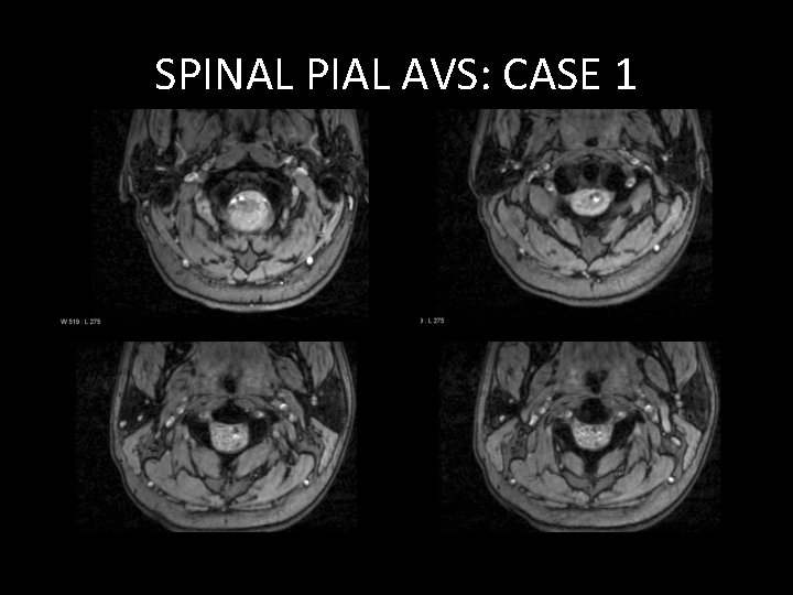 SPINAL PIAL AVS: CASE 1 SPINAL PIAL AVS: CASE 1