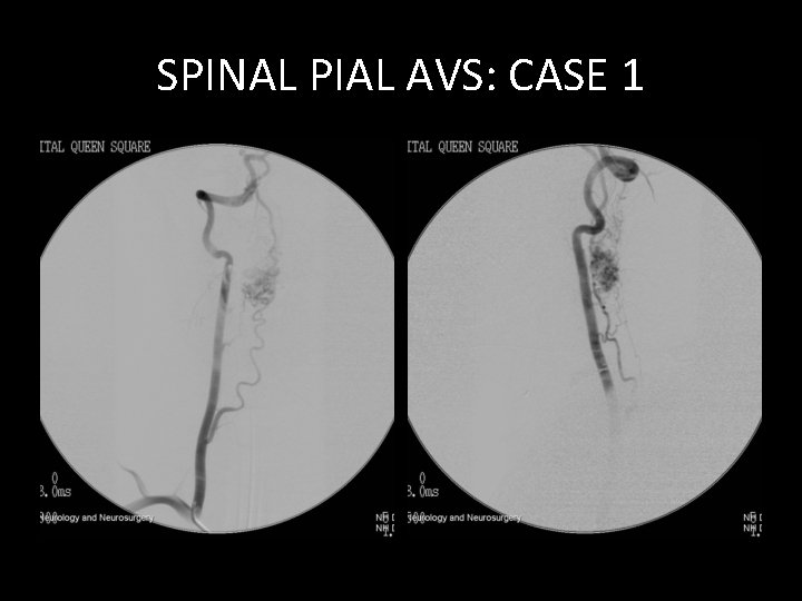 SPINAL PIAL AVS: CASE 1 SPINAL PIAL AVS: CASE 1