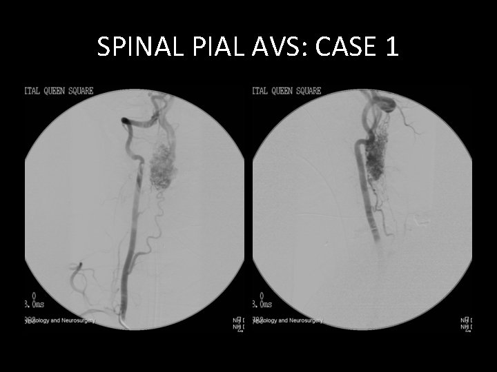 SPINAL PIAL AVS: CASE 1 SPINAL PIAL AVS: CASE 1