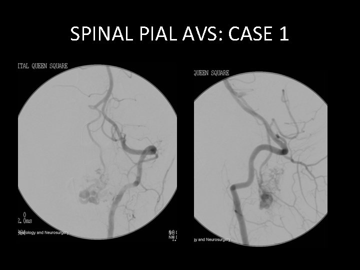 SPINAL PIAL AVS: CASE 1 SPINAL PIAL AVS: CASE 1