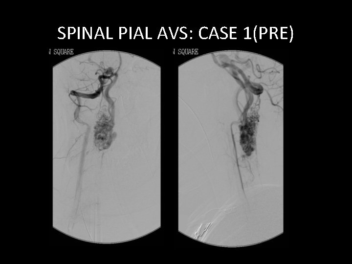 SPINAL PIAL AVS: CASE 1(PRE) SPINAL PIAL AVS: CASE 1(PRE)
