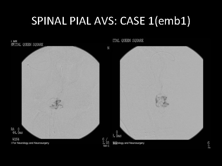 SPINAL PIAL AVS: CASE 1(emb 1) SPINAL PIAL AVS: CASE 1(emb 1)