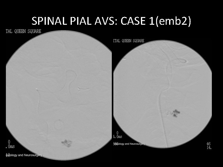 SPINAL PIAL AVS: CASE 1(emb 2) SPINAL PIAL AVS: CASE 1(emb 2)