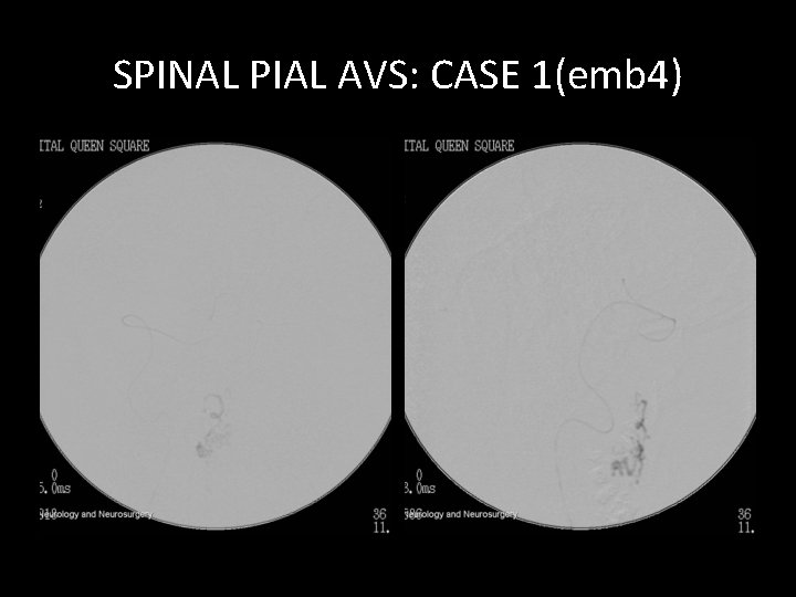 SPINAL PIAL AVS: CASE 1(emb 4) SPINAL PIAL AVS: CASE 1(emb 4)