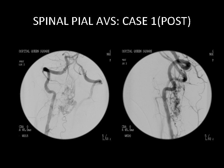 SPINAL PIAL AVS: CASE 1(POST) SPINAL PIAL AVS: CASE 1(POST)
