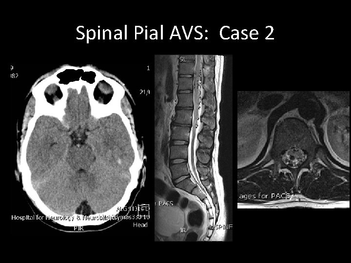 Spinal Pial AVS: Case 2 Spinal Pial AVS: Case 2