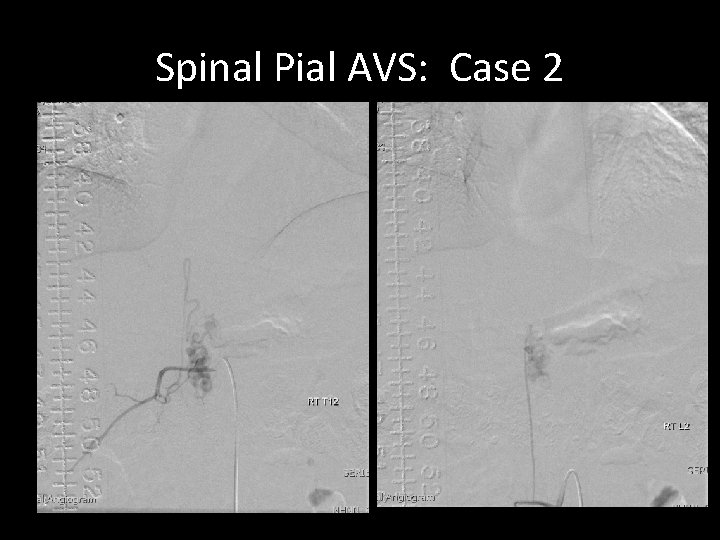 Spinal Pial AVS: Case 2 Spinal Pial AVS: Case 2