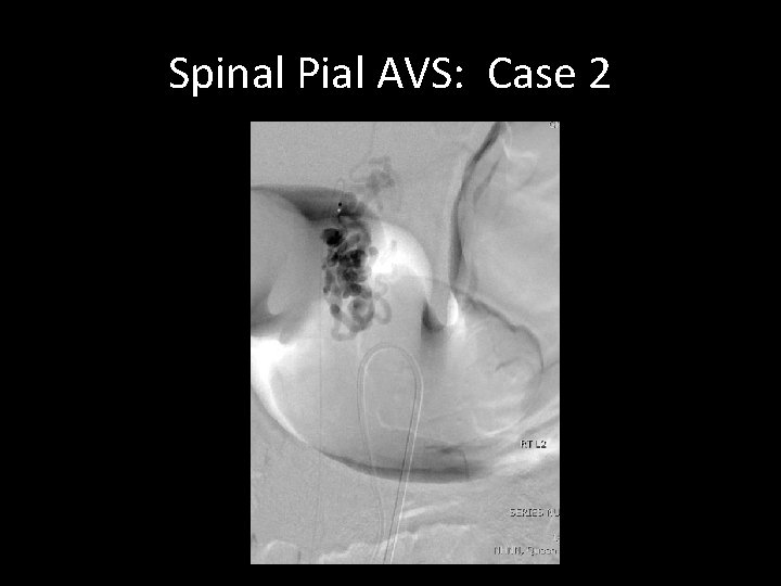 Spinal Pial AVS: Case 2 Spinal Pial AVS: Case 2