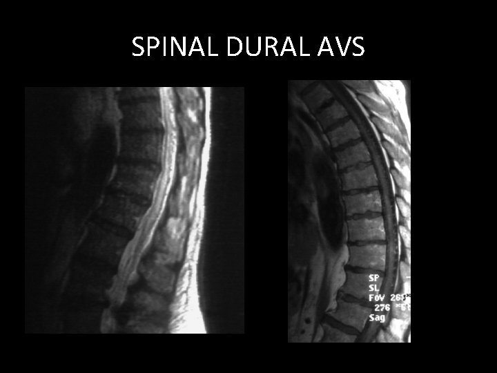 SPINAL DURAL AVS SPINAL DURAL AVS