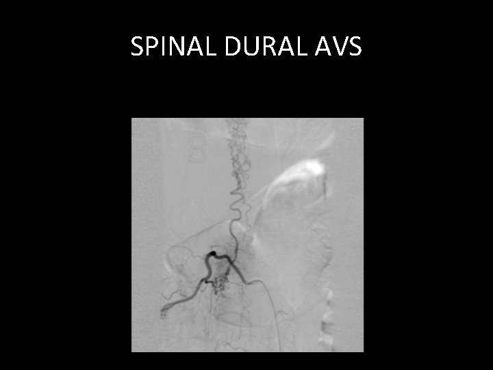 SPINAL DURAL AVS SPINAL DURAL AVS