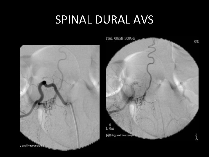 SPINAL DURAL AVS SPINAL DURAL AVS