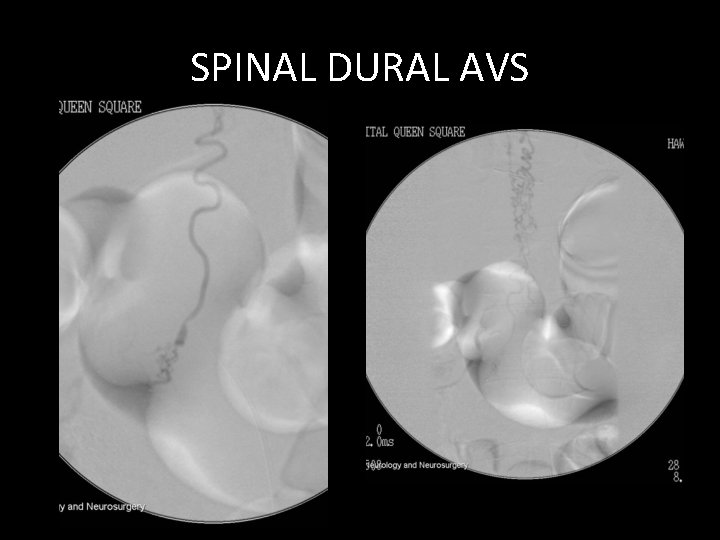 SPINAL DURAL AVS SPINAL DURAL AVS