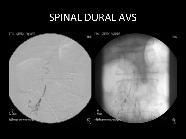 SPINAL DURAL AVS SPINAL DURAL AVS