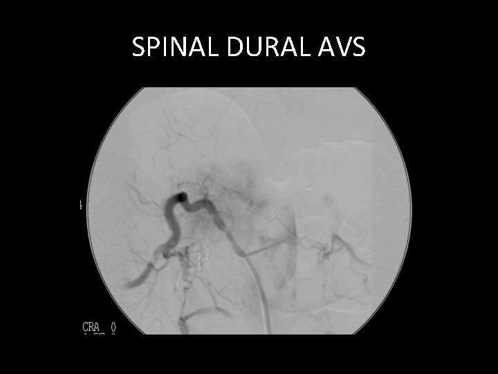 SPINAL DURAL AVS SPINAL DURAL AVS