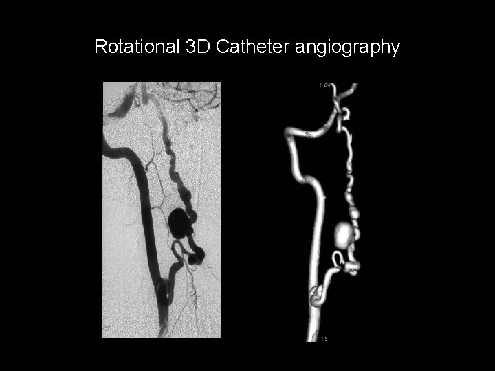 Rotational 3 D Catheter angiography Rotational 3 D Catheter angiography