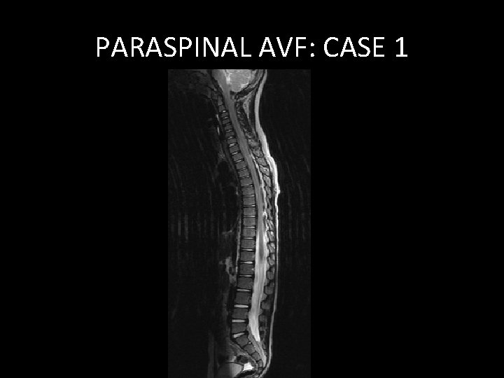 PARASPINAL AVF: CASE 1 PARASPINAL AVF: CASE 1
