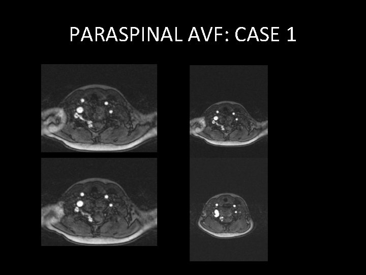 PARASPINAL AVF: CASE 1 PARASPINAL AVF: CASE 1