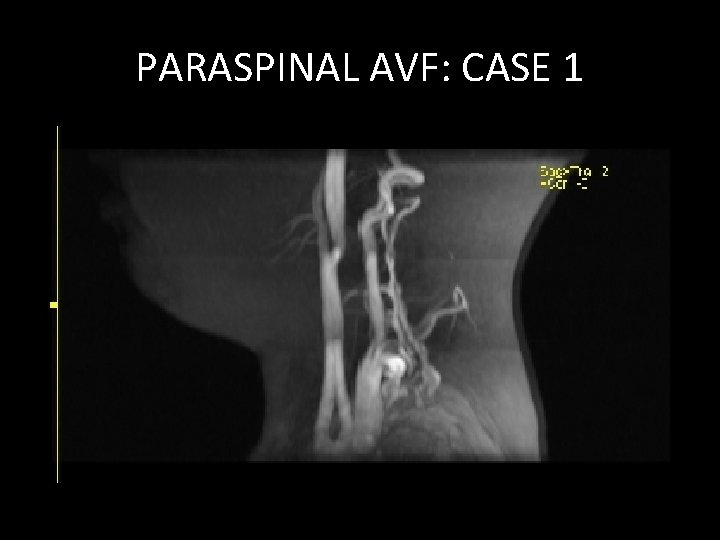 PARASPINAL AVF: CASE 1 PARASPINAL AVF: CASE 1
