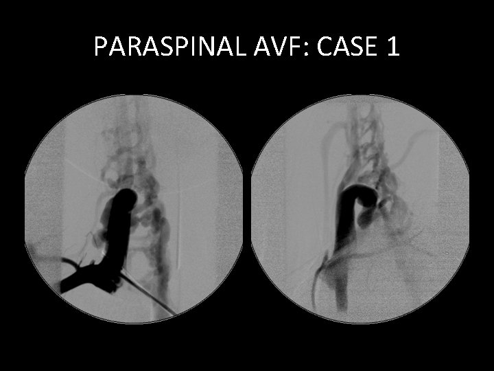 PARASPINAL AVF: CASE 1 PARASPINAL AVF: CASE 1