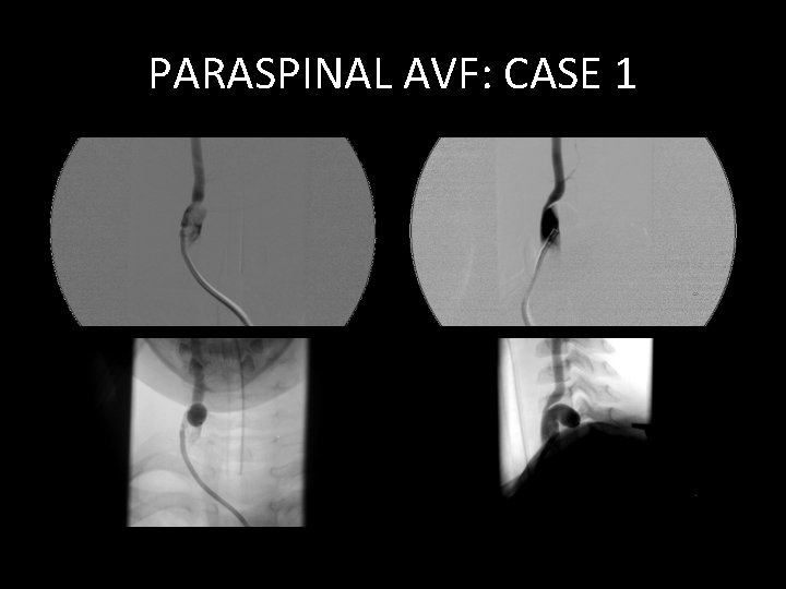 PARASPINAL AVF: CASE 1 PARASPINAL AVF: CASE 1